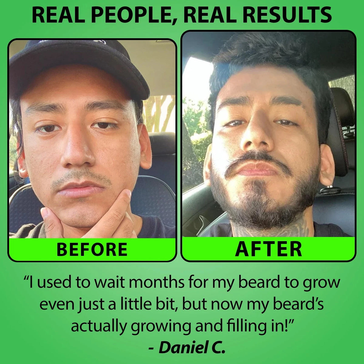 Minoxidil 5% Serum for Beard Growth (Pack of 1)
