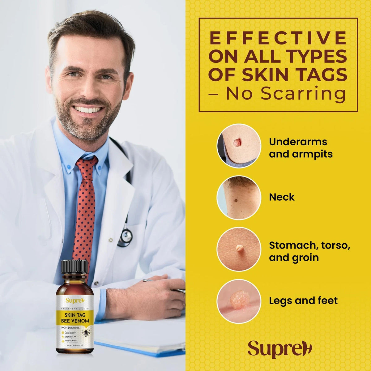 Fast-Acting Bee Venom Wart Skin Tag Remover for Men and Women (20 m)