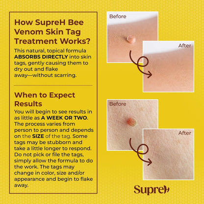 Fast-Acting Bee Venom Wart Skin Tag Remover for Men and Women (20 m)