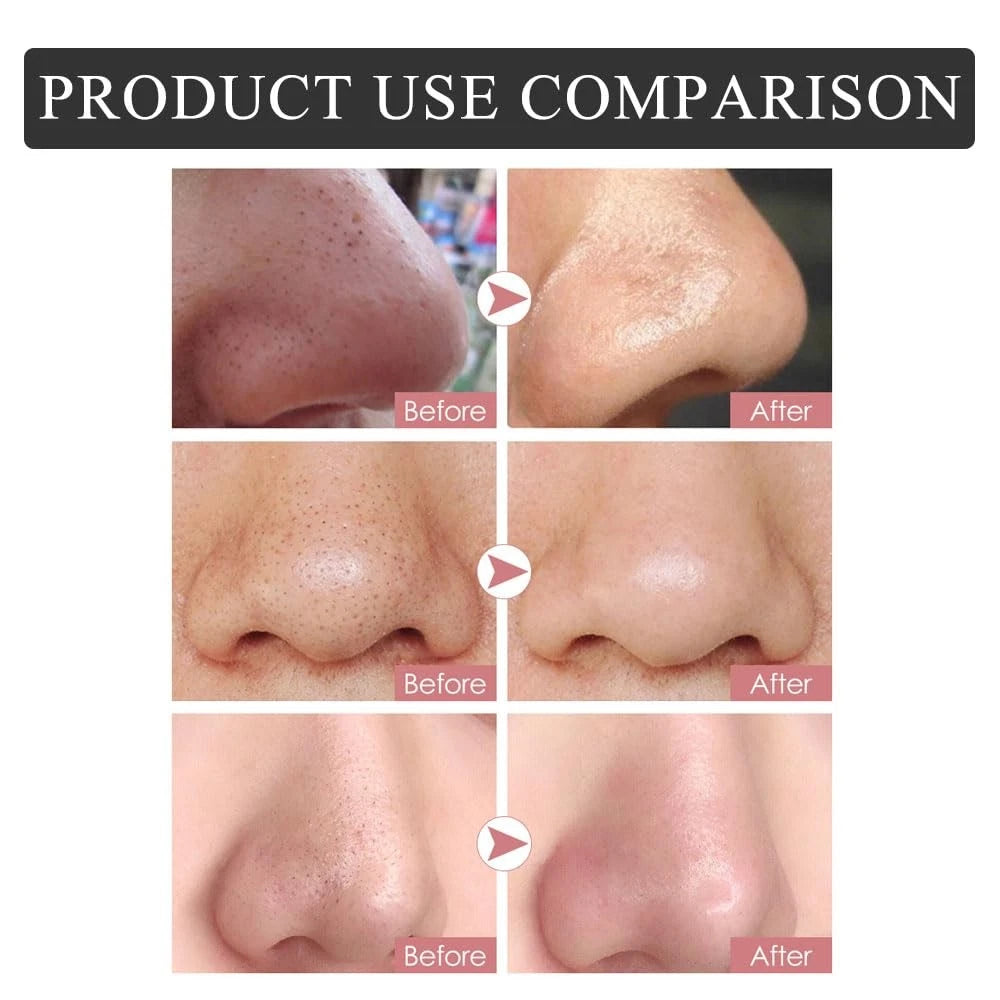 Blackhead Remover Nose Pore Strips for Deep Cleansing
