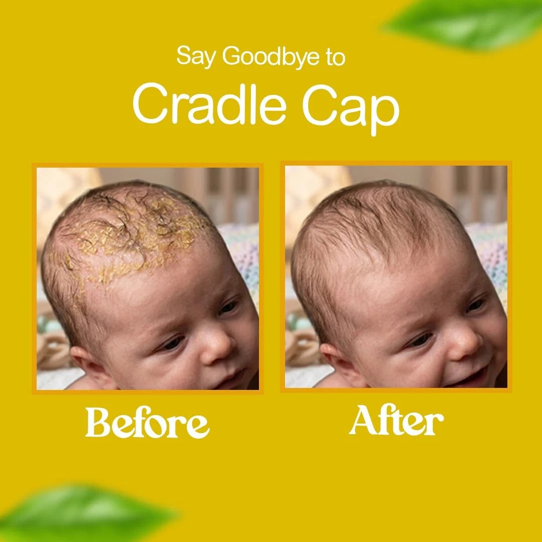2X Bee Gone Cradle Cap Shampoo 8oz for Baby (Natural & Organic)