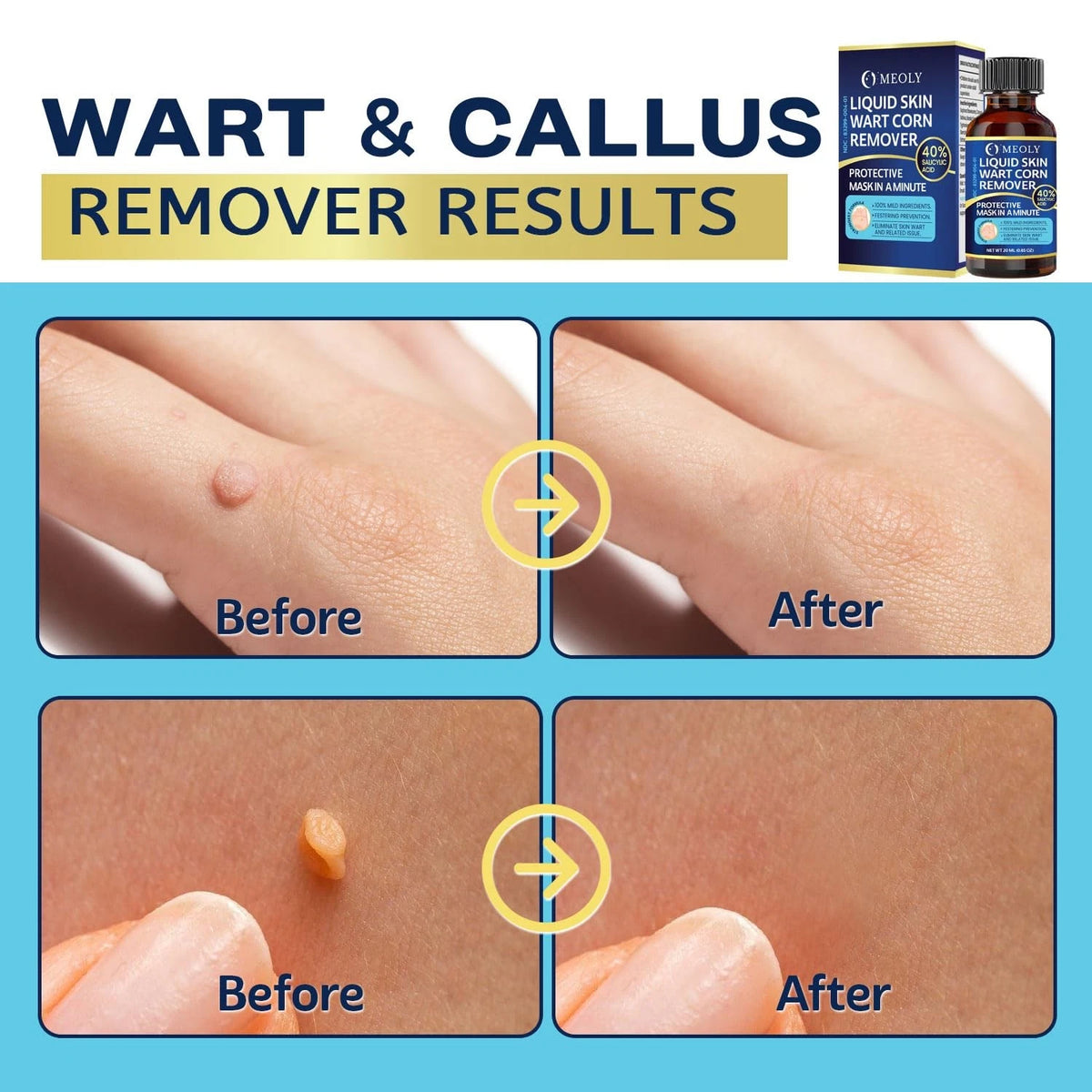 Fast-Acting Wart Remover 40% Salicylic Acid (0.96 oz)