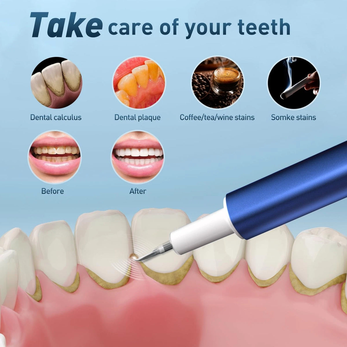 Teeth Cleaning Kit for Dental Calculus Removal (2023)