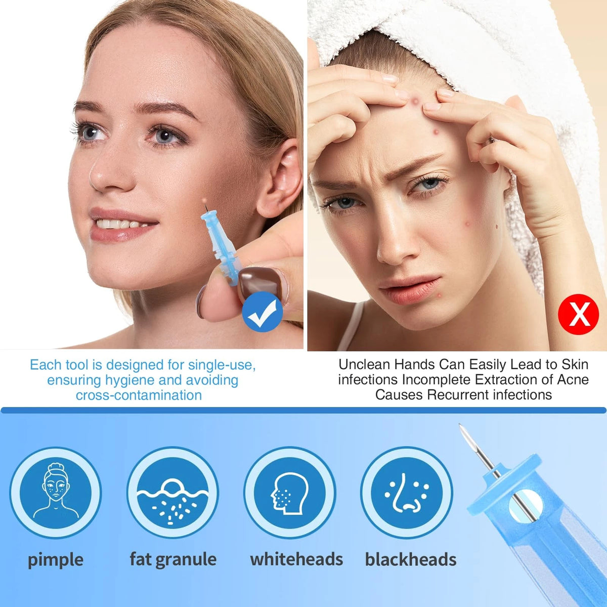 80 pcs Pimple Needle Kit for Skin Care (0.3mm)