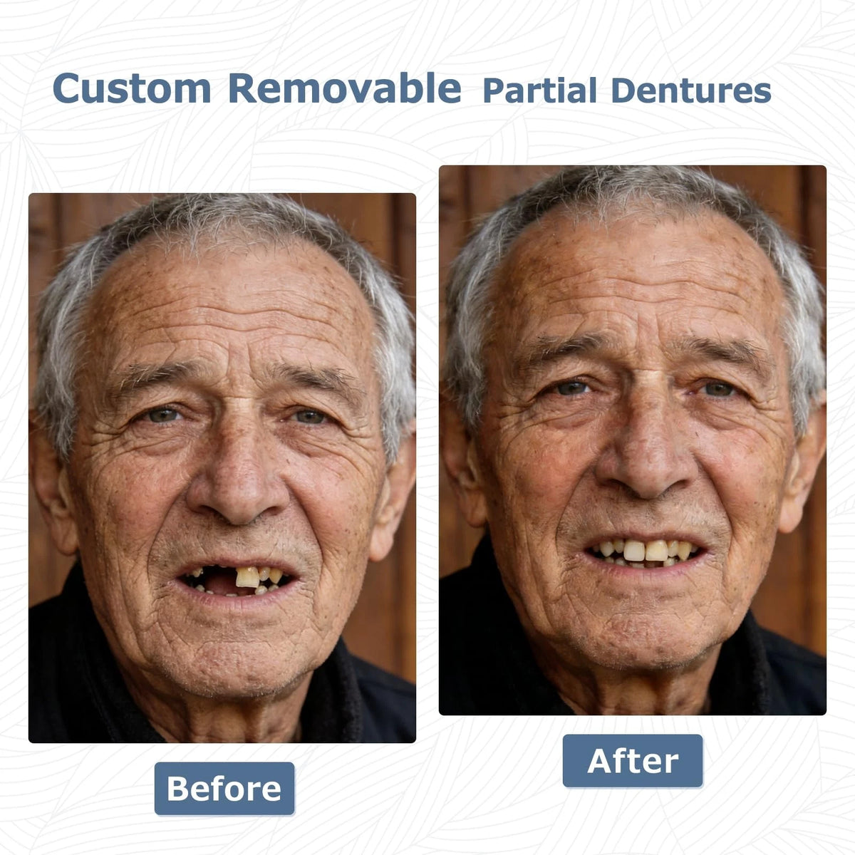 Custom Partial Dentures for 1 Tooth (Off White)